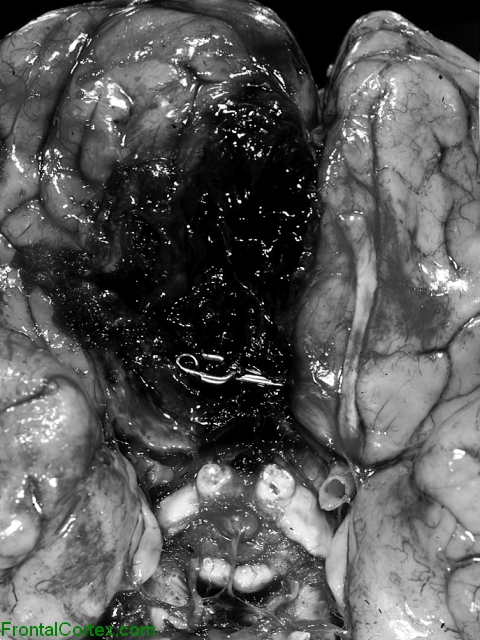 Ruptured ACoA with Clip Ventral